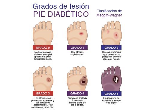 gradosdepiediabetico - Falta una mayor cultura de la prevención del pie diabético, también en Puerto Vallarta
